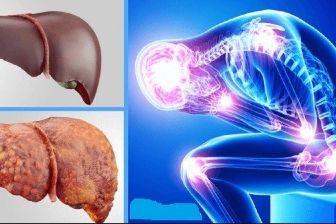 Obezite ve karaciğer yağlanması